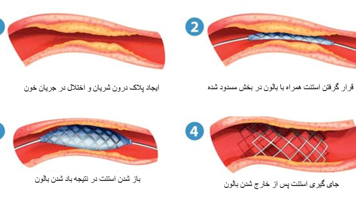 آنژیوپلاستی و استنت گذاری