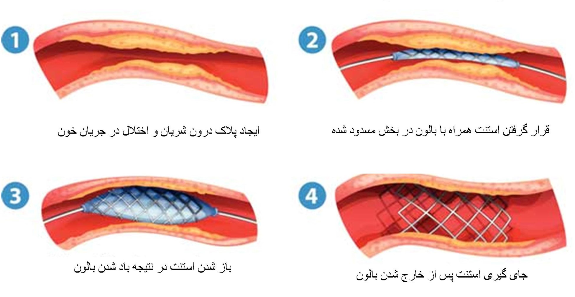 آنژیوپلاستی و استنت گذاری